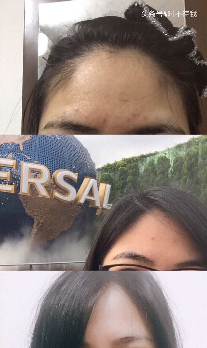 换季爆痘怎么处理,夏天容易爆痘怎么护理