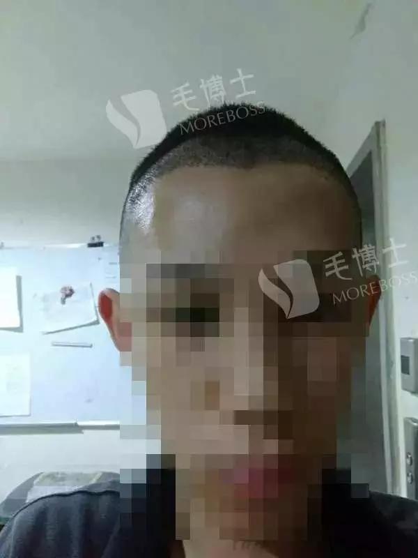 脱发到什么程度要去医院,脱发到什么等级