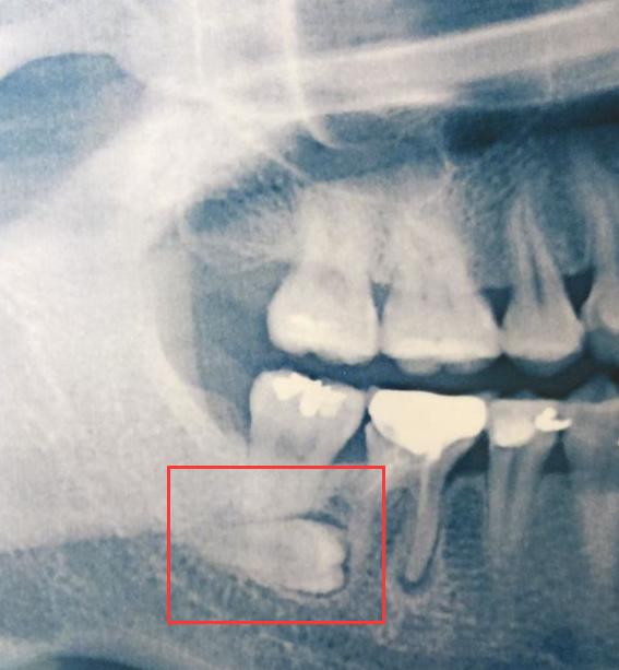 拔智齿拆线后吐口水有血色,拔智齿后吐不了棉球怎么办