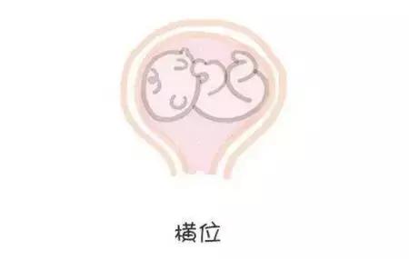 胎位不正怎么纠正胎位,胎位不正做什么动作胎位才正