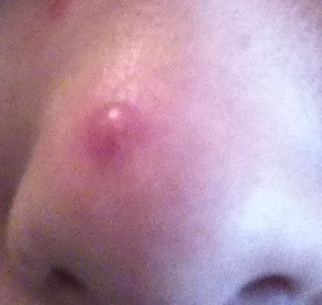 鼻子脸部挤出白色线状米粒是什么,鼻子上挤出的白色条状物到底是啥