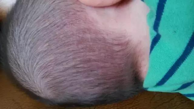 孩子热痱子怎么治好得快,小孩热痱子怎么治好得快