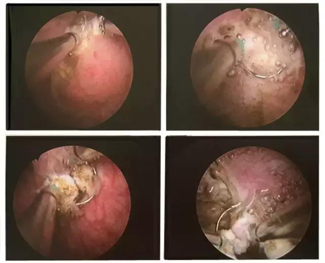肿瘤早期手术切除复发及时发现,早期无症状肿瘤手术切除