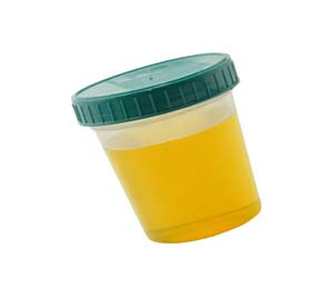 肾病尿蛋白辨证论治,关于蛋白尿还得避开2大误区