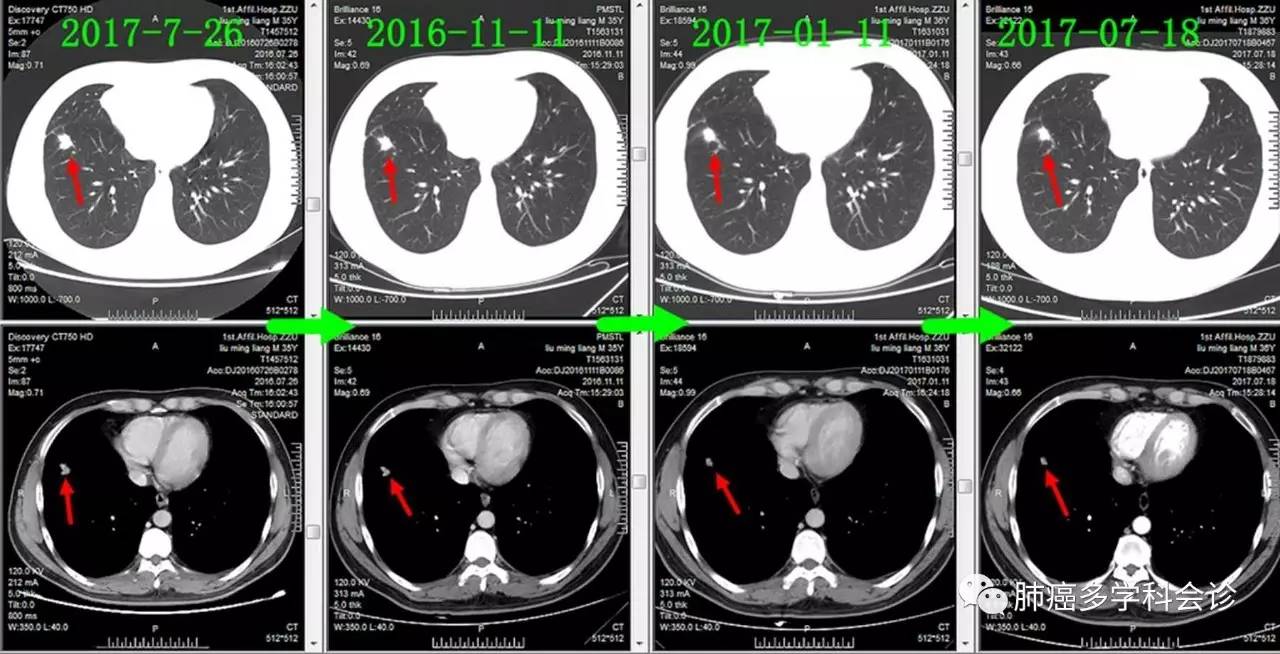 食管癌转移两侧淋巴癌严重吗,食管癌转移和扩散区别