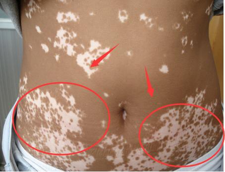 白癜风治疗为什么这么贵,白癜风长的哪个部位最难治