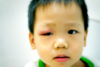 眼睛附近红肿长小颗粒是怎么回事,眼睛周围有密密麻麻小颗粒怎么治