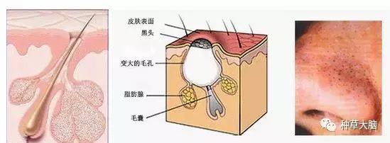 比较温和的去黑头方法,现在比较靠谱的去黑头方法