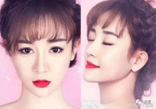 做了个达拉斯隆鼻，假体直接戳到脑门，我是不是和张檬、刘雨欣遇到了同一个医生！