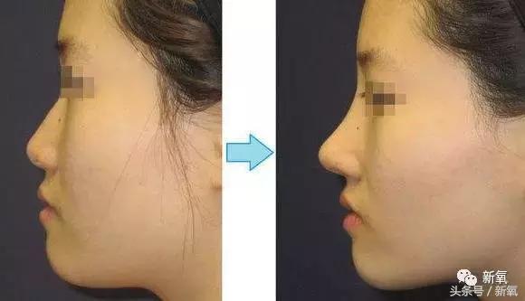 做了个达拉斯隆鼻，假体直接戳到脑门，我是不是和张檬、刘雨欣遇到了同一个医生！