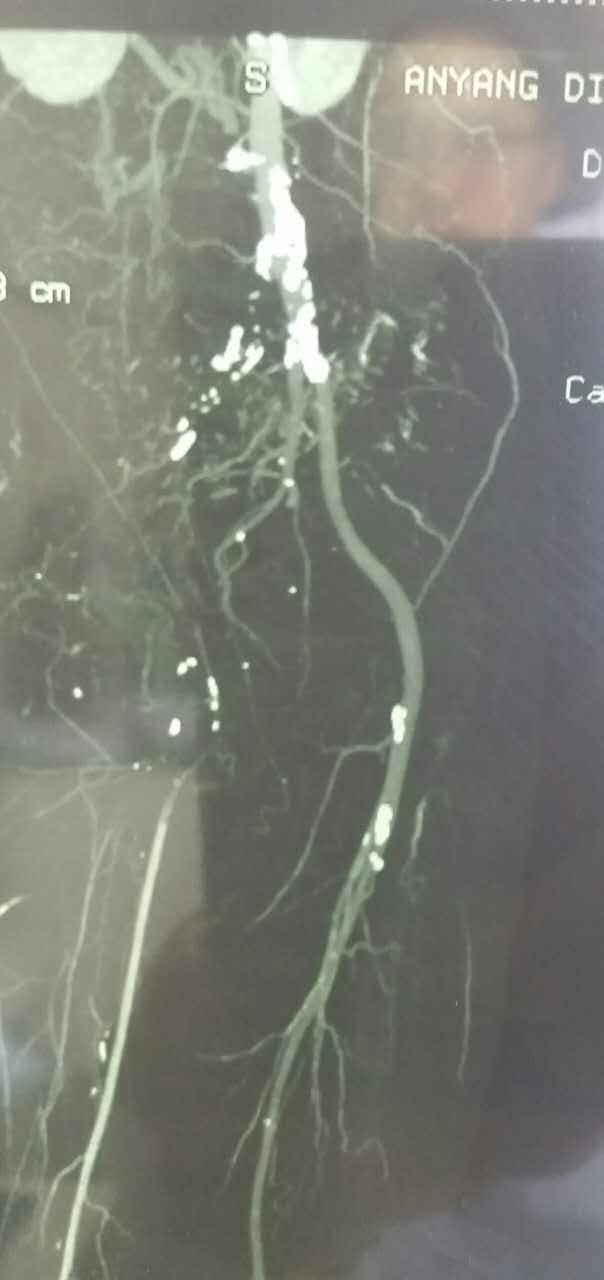 治下肢血栓闭塞脉管炎中药方,下肢动脉慢性血栓闭塞