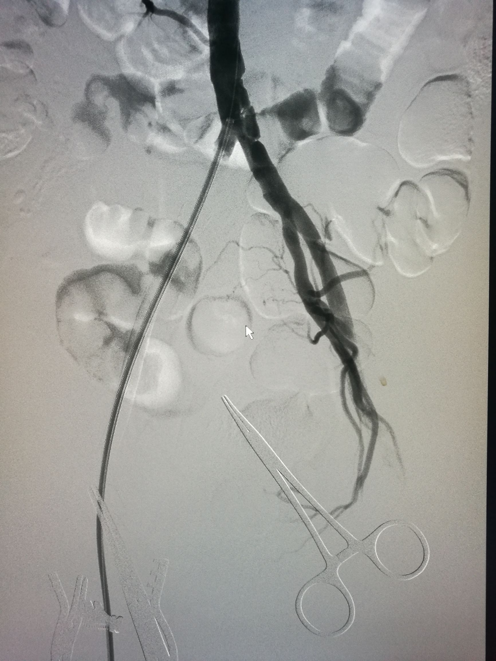 治下肢血栓闭塞脉管炎中药方,下肢动脉慢性血栓闭塞