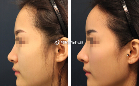 做假体下巴用硅胶好还是膨体好,下巴假体是做膨体好还是硅胶好