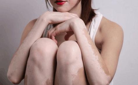 打针治疗白癜风有什么好处,白癜风新技术打针就能治疗