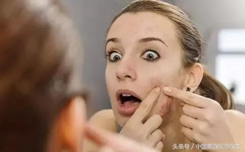 青春期痤疮中药治疗,青春期长疮怎么消除