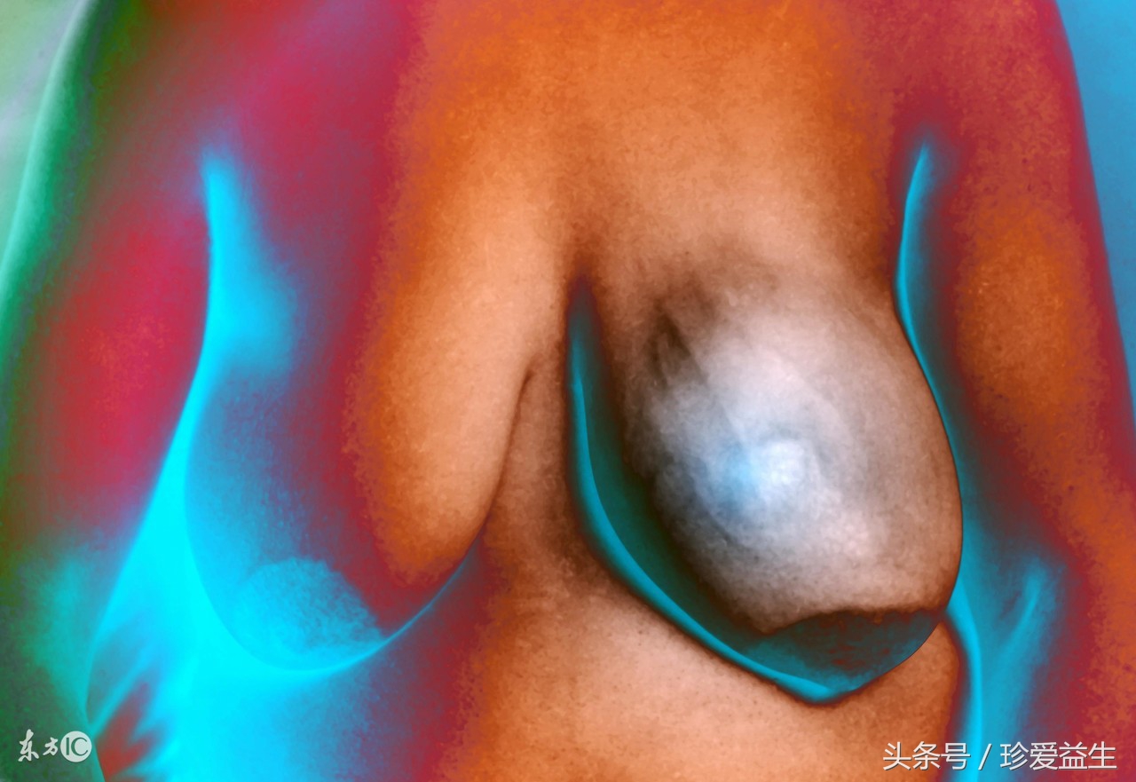 你知道，你已深陷肿瘤的包围圈吗？