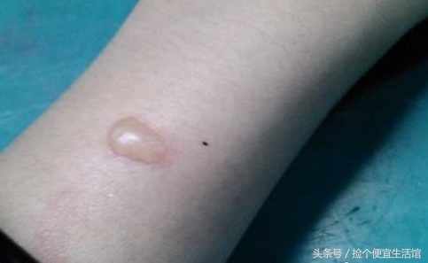 生活中烫伤应该如何自救,生活中的烫伤