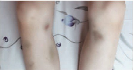 皮肤青一块紫一块是白血病吗,四岁小孩腿上多处青的是什么原因