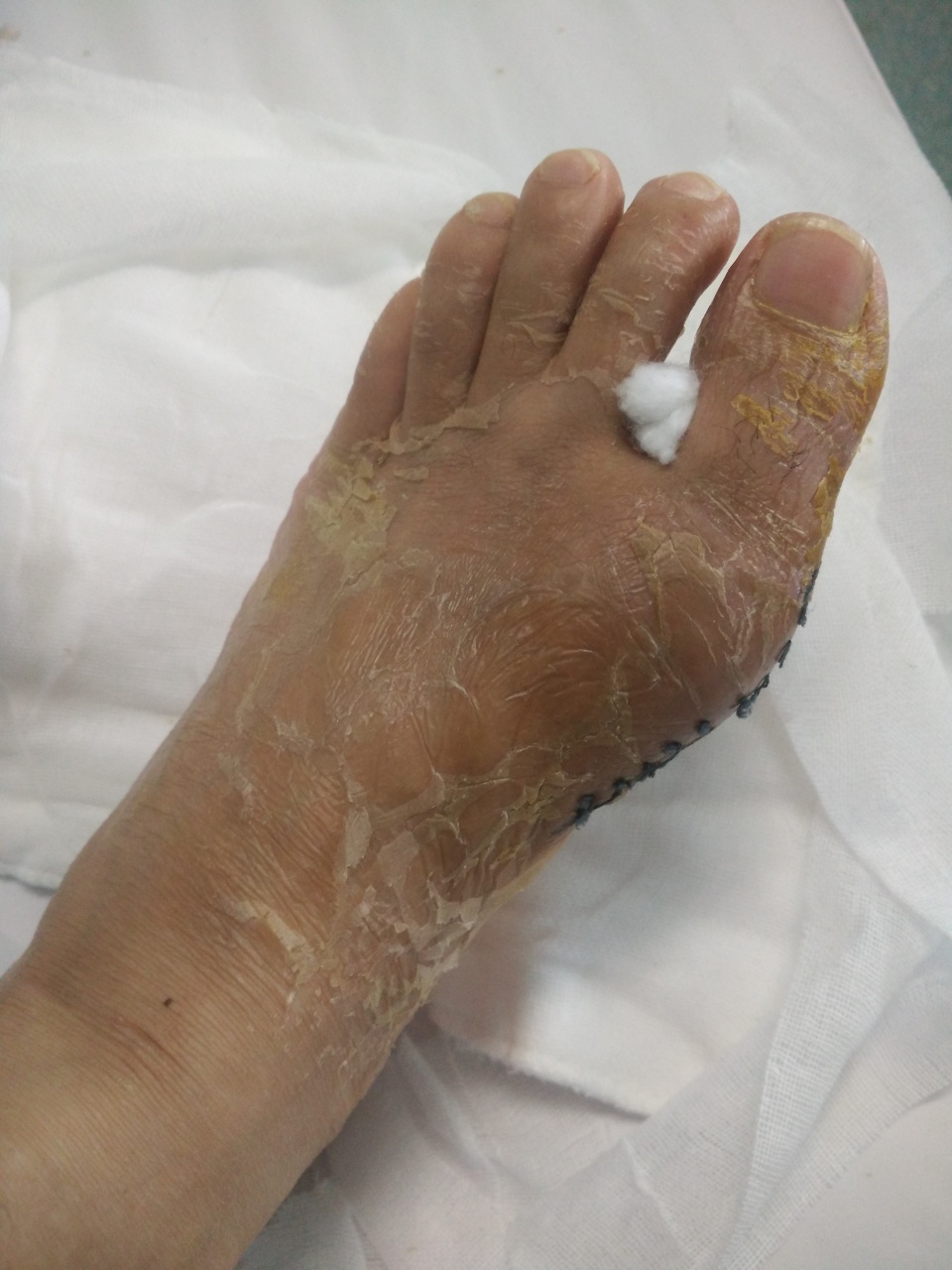 痛风还得是刚做完手术的飞哥跟你聊