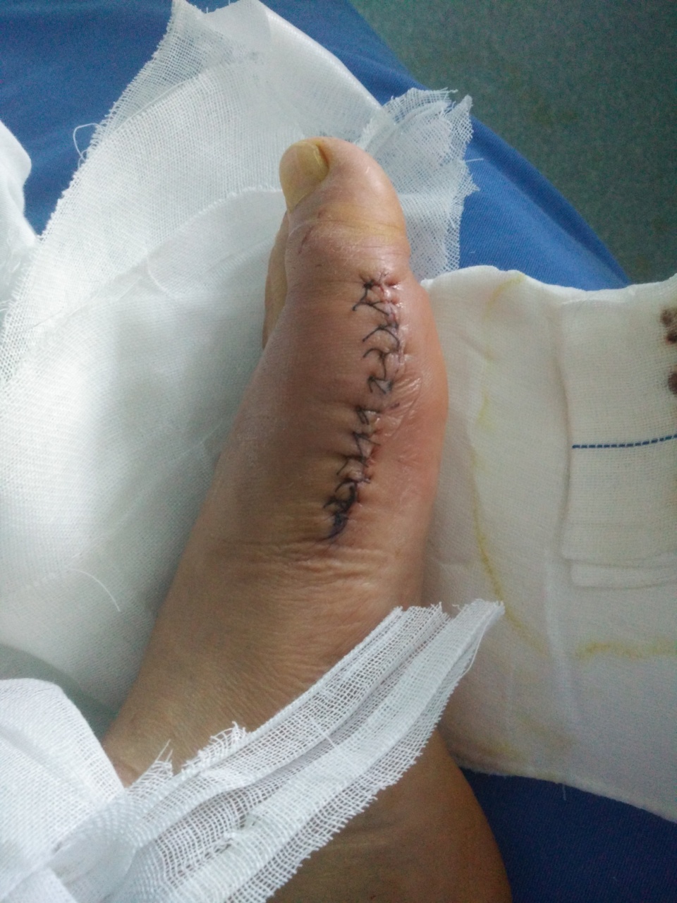 痛风还得是刚做完手术的飞哥跟你聊