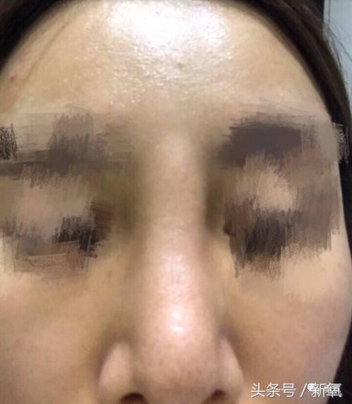 做了个达拉斯隆鼻，假体直接戳到脑门，我是不是和张檬、刘雨欣遇到了同一个医生！