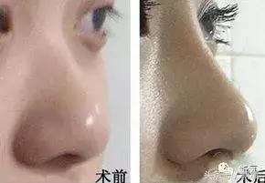 做了个达拉斯隆鼻，假体直接戳到脑门，我是不是和张檬、刘雨欣遇到了同一个医生！