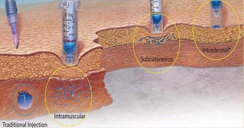 无针注射器推荐排行,无针头注射器优缺点