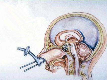 泌乳素垂体瘤为什么不建议手术,泌乳素垂体瘤手术风险