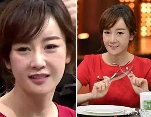 做了个达拉斯隆鼻，假体直接戳到脑门，我是不是和张檬、刘雨欣遇到了同一个医生！