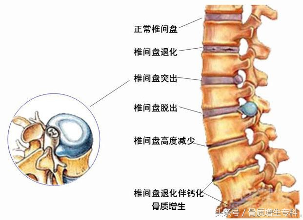 腰椎间盘突出和骨质增生能治好吗,用药物能治疗腰椎间盘突出吗