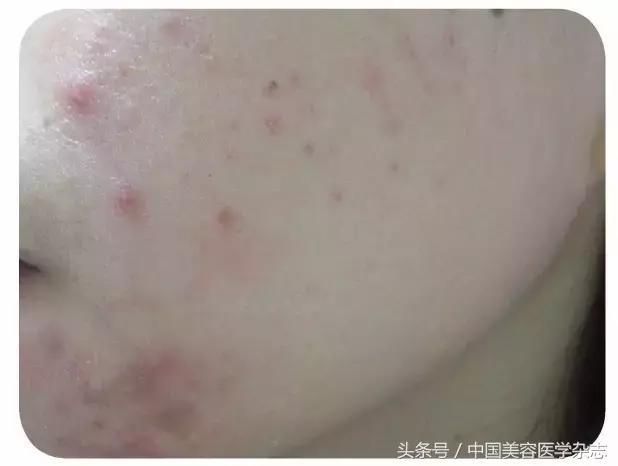 青春期痤疮中药治疗,青春期长疮怎么消除