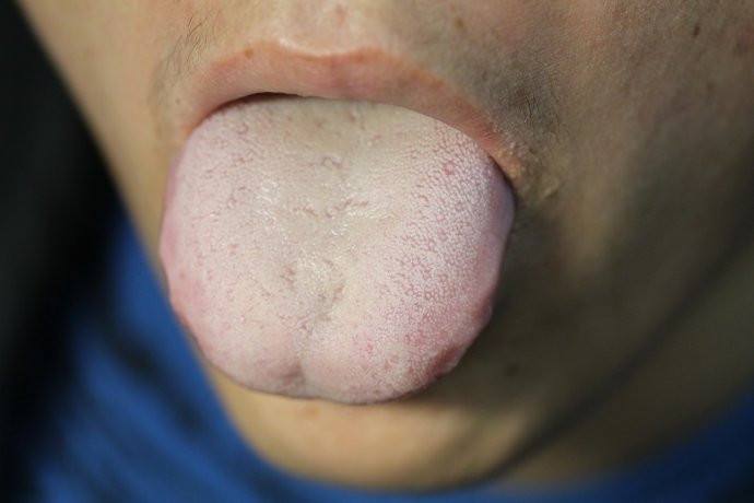 湿气寒热如何区分,湿气重怎么判断是寒湿还是湿热