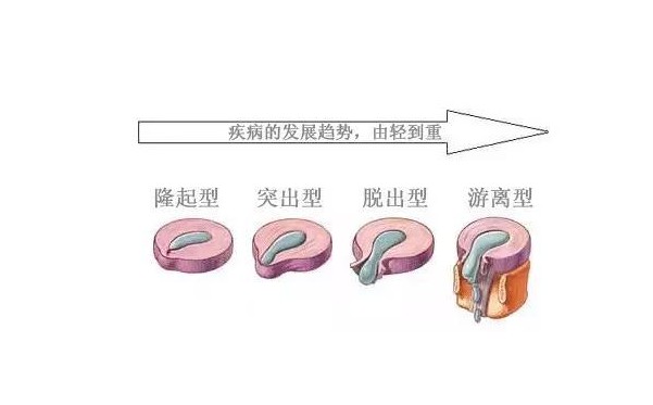 腰疼扯着屁股疼是怎么回事,腰疼扯着腿疼能自愈吗
