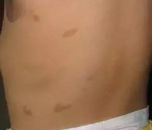 宝宝身上有5个胎记,孩子身上有10块胎记