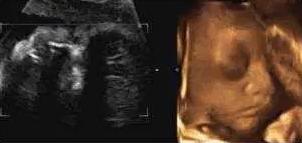 四维彩超宝宝不配合宝爸怎么做,做四维胎宝宝不配合说明什么