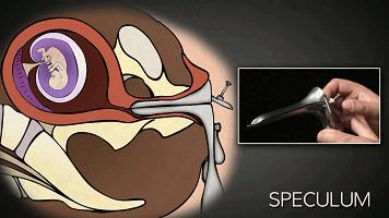 五个月无痛引产跟一般引产的区别,迫不得已做引产