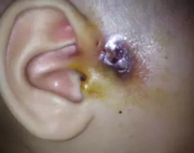 耳朵上有小洞到底有多可怕,耳朵上有个小孔后天形成