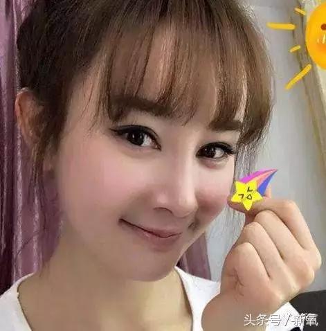 做了个达拉斯隆鼻，假体直接戳到脑门，我是不是和张檬、刘雨欣遇到了同一个医生！