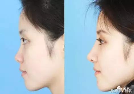 做了个达拉斯隆鼻，假体直接戳到脑门，我是不是和张檬、刘雨欣遇到了同一个医生！