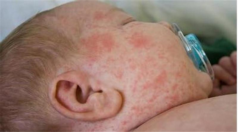 宝宝痱子治疗最好最快最有效,有什么东西能把宝宝痱子快速去掉