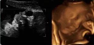 四维彩超宝宝不配合宝爸怎么做,做四维胎宝宝不配合说明什么