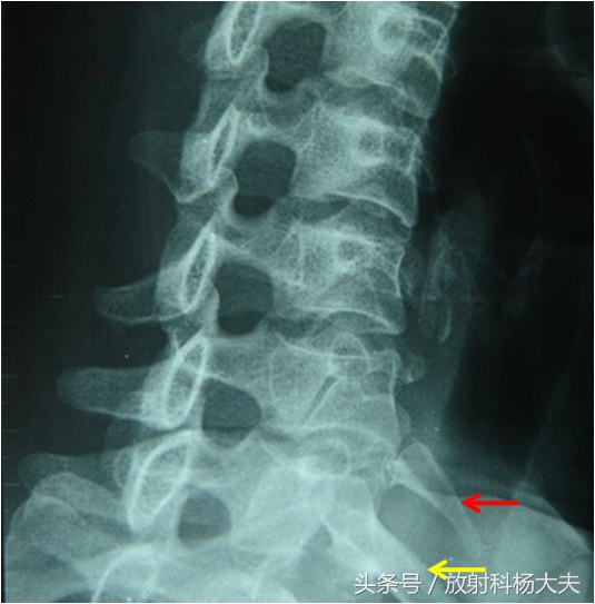 中年男人脖子长包并有一条沟,中年男性脖子后面有大包