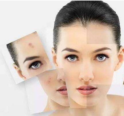 皮肤科医生建议淡化痘印的方法,顽固痘印怎么祛除医美