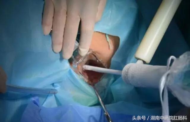 低位直肠癌冷冻治疗,直肠癌冷冻