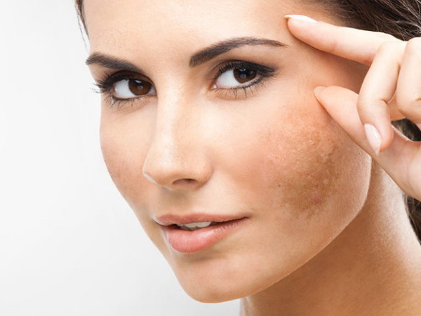 褐斑是什么样子的图片,褐斑简介