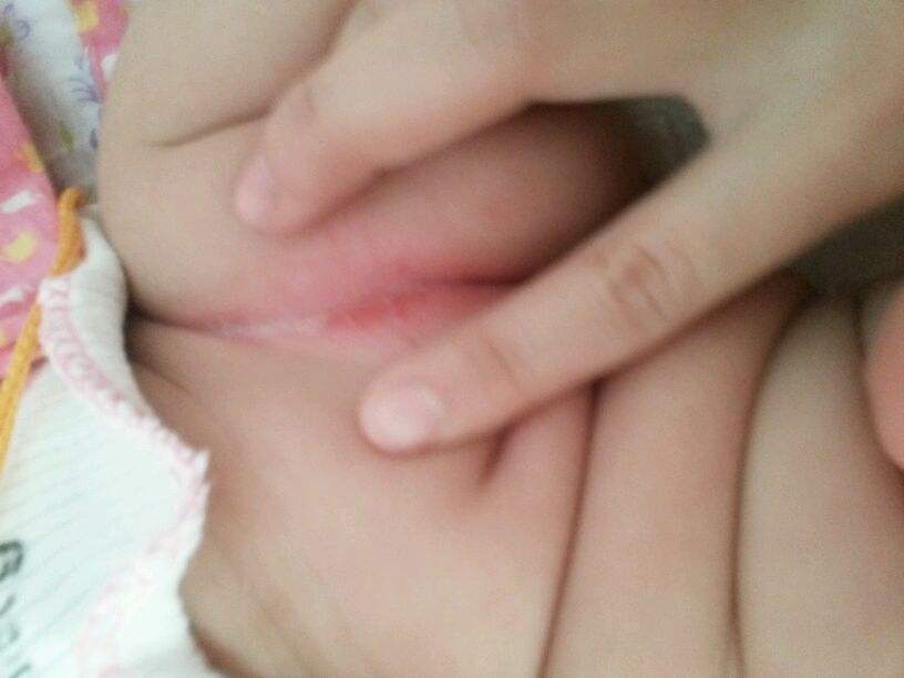 防止宝宝脖子被淹擦什么,宝宝脖子被淹为什么要用茶水洗