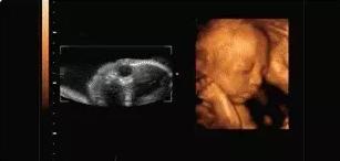 四维彩超宝宝不配合宝爸怎么做,做四维胎宝宝不配合说明什么