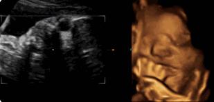 四维彩超宝宝不配合宝爸怎么做,做四维胎宝宝不配合说明什么