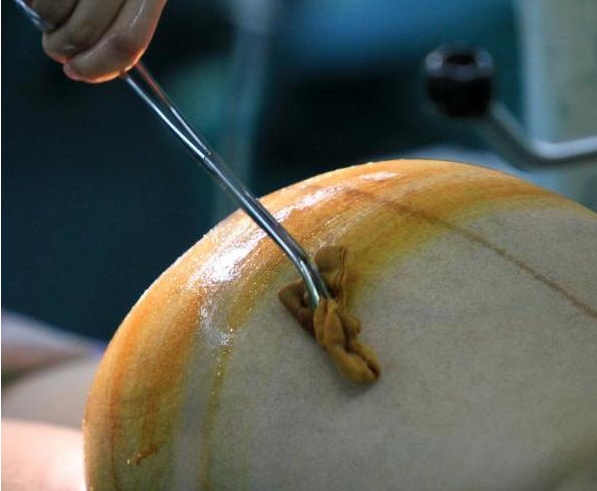 剖腹产全部流程记录,顺产剖腹产的十个真相