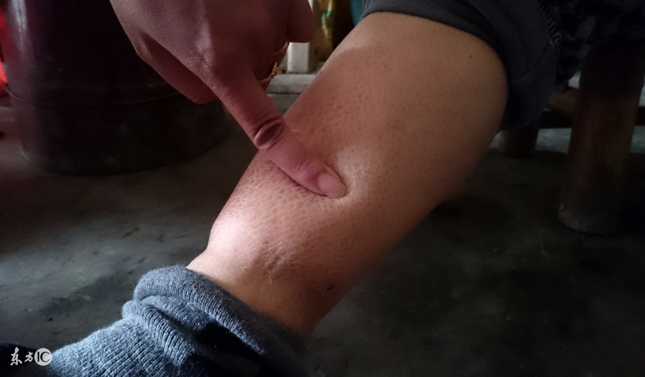 小心乱吃药当心导致尿毒症服药需遵医嘱不可擅自服药